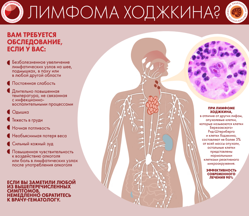 Неходжкинская лимфома картина крови